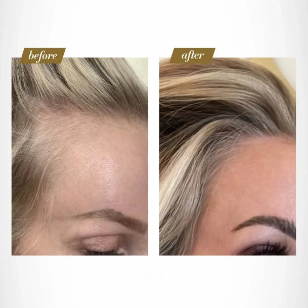 Folix22™ Hair Roller Therapy